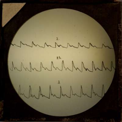 Lantern Slide: Diagram of heart rhythm