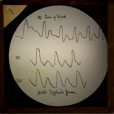 Lantern Slide: Diagram of heart rhythm -- loss of blood and typhoid fever